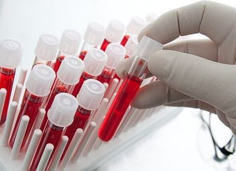 blood tests for the diagnosis of arthritis and osteoarthritis