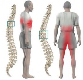 damage to the spine and pain in thoracic osteochondrosis