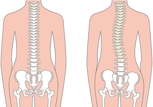 Low back pain due to spinal deformity such as scoliosis. 