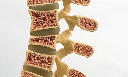 Osteoporosis is one of the causes of low back pain. 