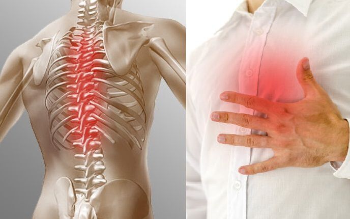 Thoracic osteochondrosis and chest pain.
