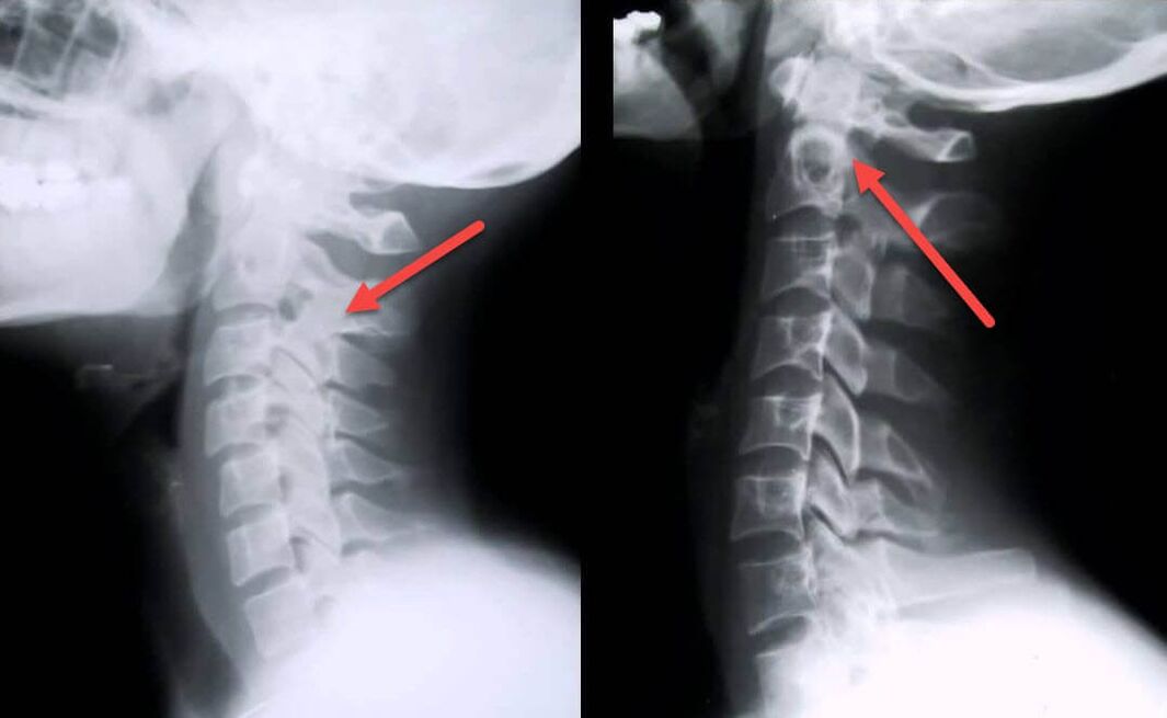 Manifestations of osteochondrosis of the cervical spine on radiography.