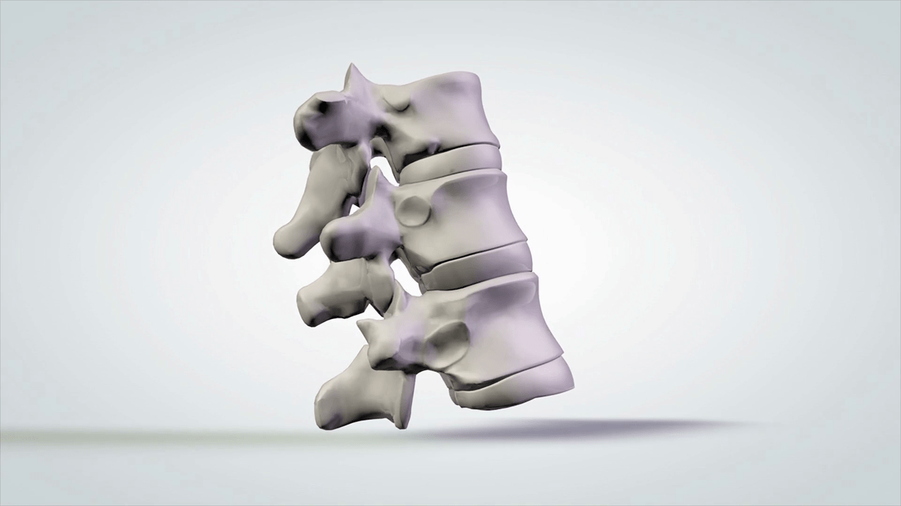 Damage to the spine due to cervical osteochondrosis.
