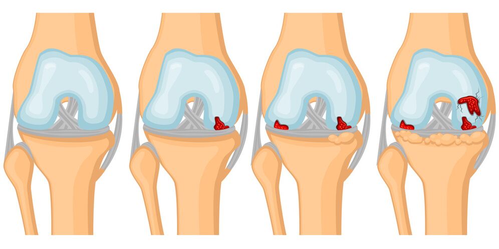 Degree of development of joint osteoarthritis.